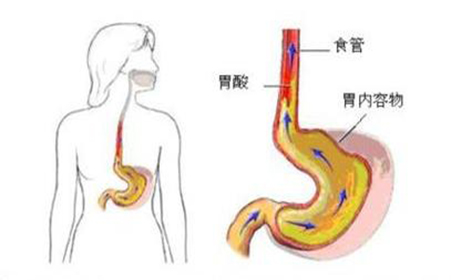 反流性食管炎有哪些明显的症状